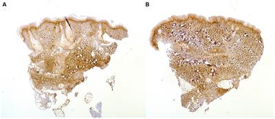 Periostin expression in uninvolved skin as a potential biomarker for rapid cutaneous progression in systemic sclerosis patients: a preliminary explorative study